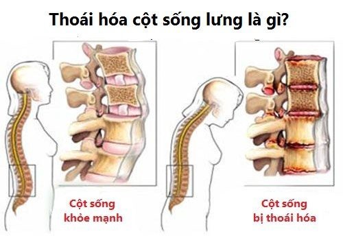 thoái hóa cột sống, triệu chứng, nguyên nhân